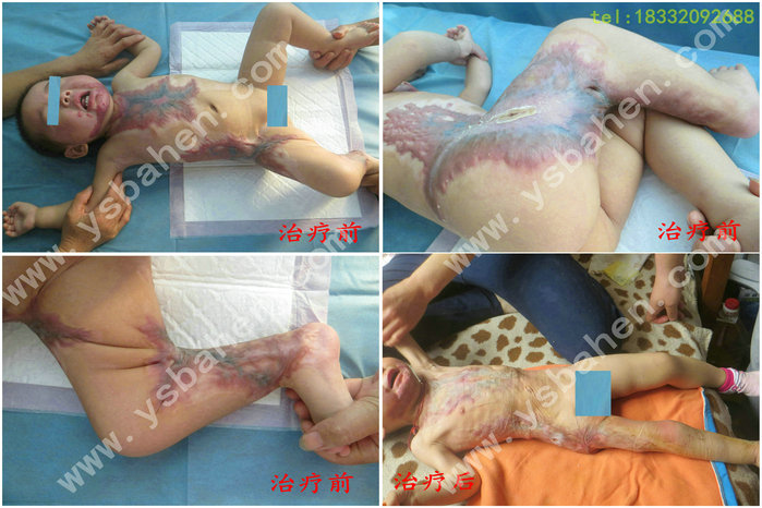 疤痕增生及牵拉15