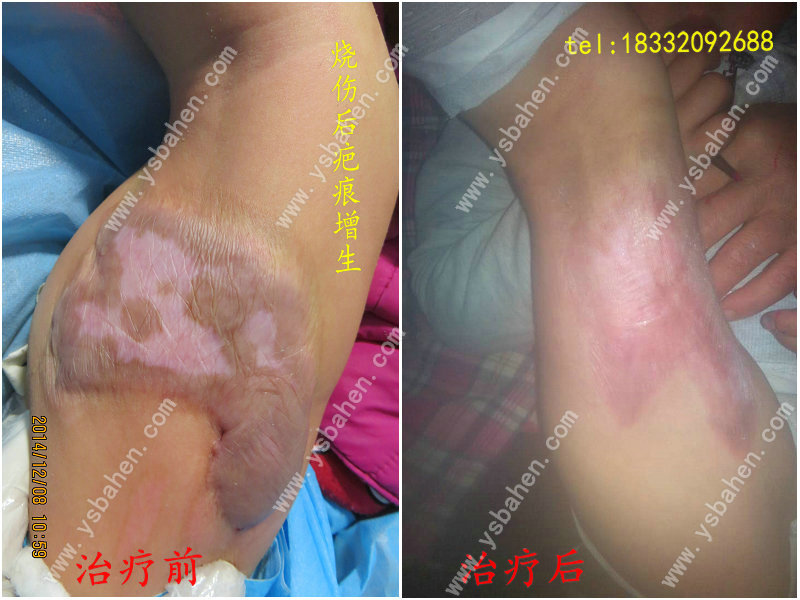 疤痕增生及牵拉13